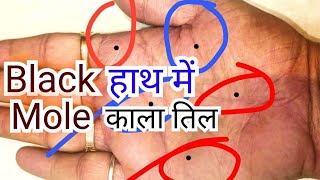 Black Mole on palm, हथेली में kala till