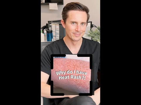 Heat Rash remedy and causes