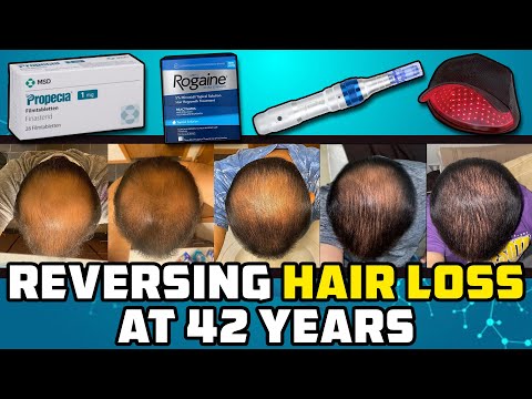 He Let Himself Go Bald, Then At 42 He Tried Reversing It And This Is What Happened...