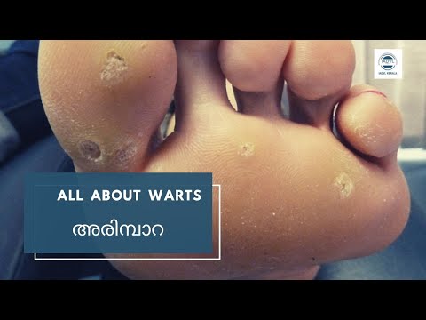 All about Warts
