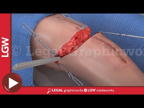 Above the Knee Amputation Surgery 3D animation