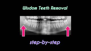 Lower Wisdom Teeth Extractions