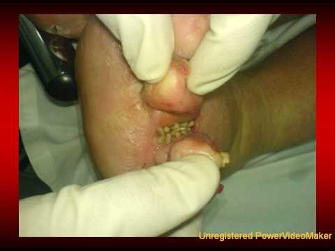 comment guerir gale dans le nez