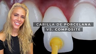 5 grandes diferencias entre Carillas de Porcelana y Composite 👩🏼‍⚕️🦷
