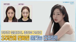 밋밋한 얼굴라인, 중안부 고민엔 울타늄 리프팅