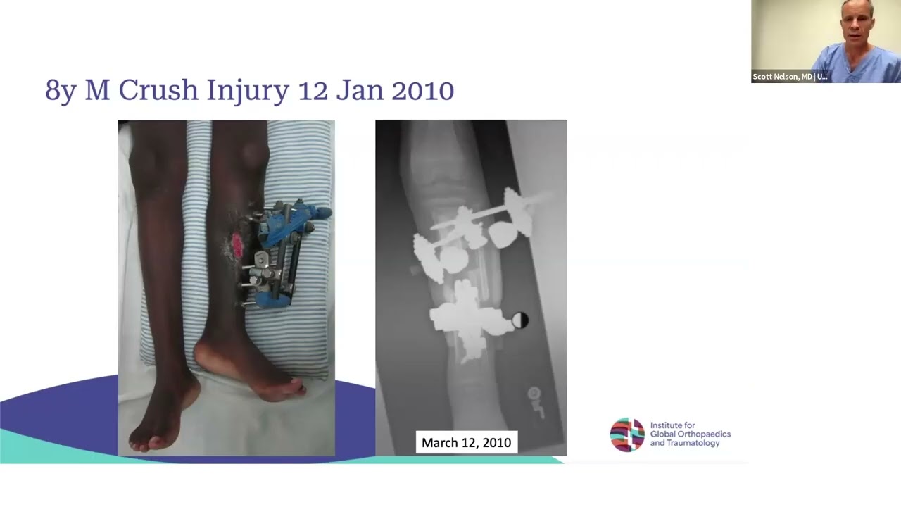 2025 UCSF IGOT Pediatric Limb Differences Webinar – Session 3: Non unions and Bone Loss