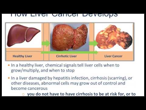 PATIENT ED - TREATMENT OPTIONS FOR LIVER CANCER by Dr. Robert Gish