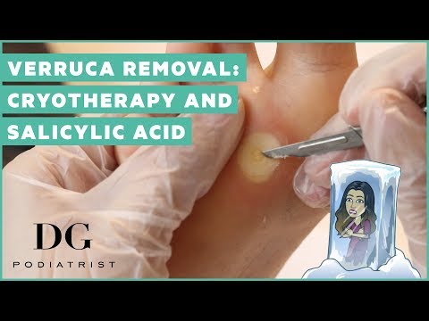 Verruca removal cryotherapy and salicylic acid Video