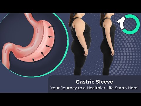 Laparoscopic Gastric Sleeve (Sleeve Gastrectomy) - Surgical Procedure - One Clinic Patient Review Video