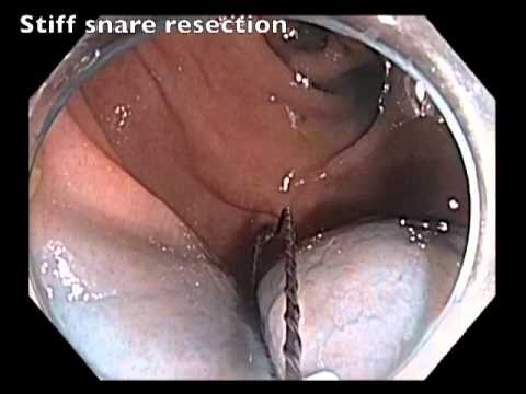 EMR of Subtle Flat Lesion in Cecum