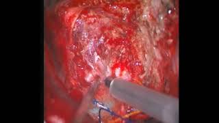 Download Lagu Right clinoid meningioma. Agung Budi Sutiono, MD, PhD Thumbnail