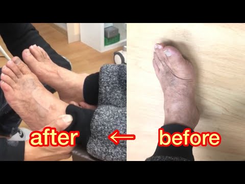 足の脱臼 – 脱臼の概要、症状、治療方法