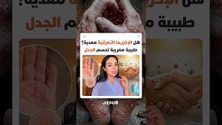 هل تشكل "الإكزيما التعرقية" خطرا على المحيطين بالمصاب؟ طبيبة مغربية توضح حقيقة المرض thumbnail