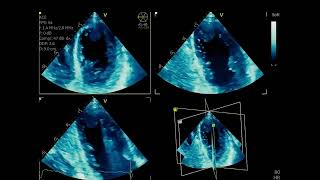 Asvide: Two-dimensional TTE, apical triplane view, showing a large highly mobile apical thrombus...