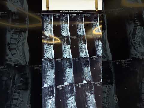 From Pain to Recovery: Spine Infection Treatment Success Story with Dr. Ajay Kothari