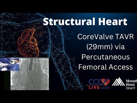 CoreValve TAVR (29mm) via Percutaneous Femoral Access Structural Heart Live Cases - April 2015