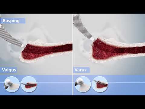 Implantation of the calar guided optimys stem