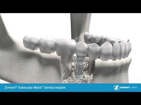 Dental Implant - Trabecular Metal Patient Education Video