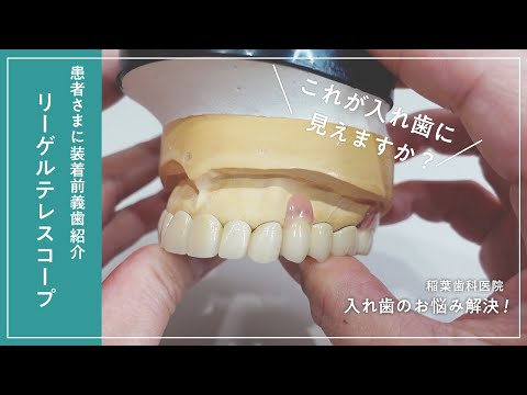 金属のみえないドイツ式部分入れ歯〜リーゲルテレスコープのご紹介〜