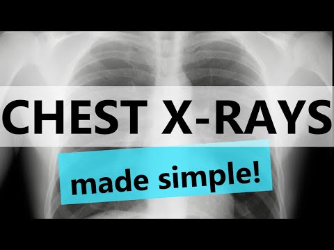 Chest X-rays (CXR) made easy! | COMPLETE GUIDE IN 12 MINUTES