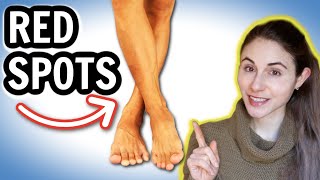 Why you get RED SPOTS ON THE LEGS & HOW TO GET RID OF THEM // Dermatologist @DrDrayzday