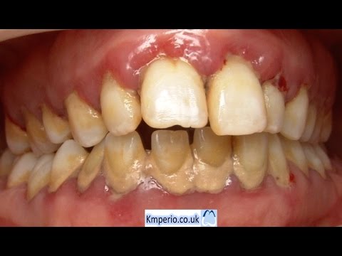 Treatment of Gum (Periodontal) Disease.