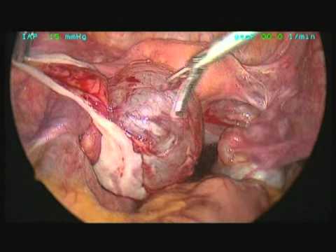 Benign Ovarian Cyst - Laparoscopic Excision