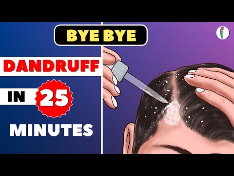 🔥#1 Dandruff Treatment at Home | How to get rid of...