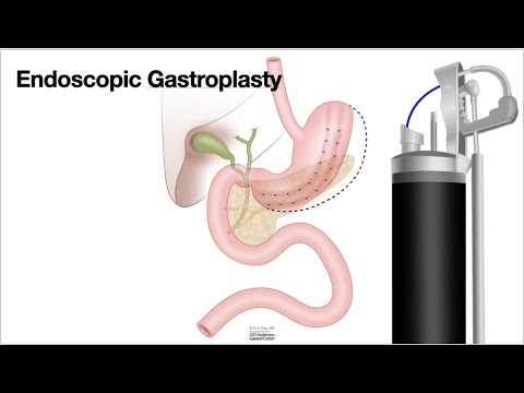 HCC 1475 10r  Surgical Anatomy Endoscopic Gastroplasty