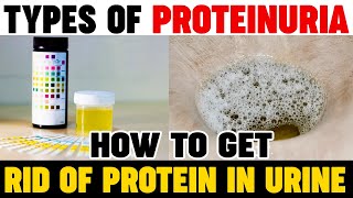 Types Of Proteinuria | How To Get Rid Of Protein In Urine | Kidney Expert