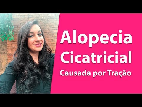 <h1 class=title>Alopecia Cicatricial Causada por Tração - Com Luciana Oliveira</h1>