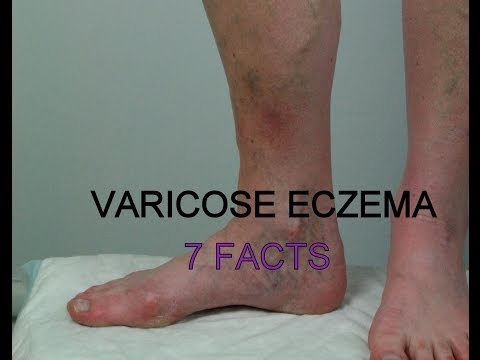 Quello che la psoriasi di stadi ha Rassegne di cura efficace di psoriasi