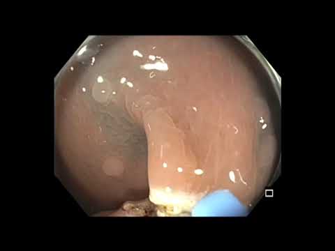 Colonoscopy: Rectosigmoid Tethered Polyp after Incomplete Resection - Hot Snare