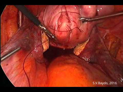Miomectomía múltiple laparoscópica con isquemia controlable