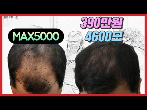 390万韩元的毛发移植费用，毛发移植到此为止。 介绍植发前后。