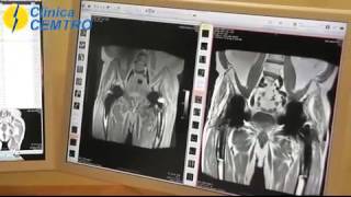 Tengo una prótesis, ¿puedo realizarme una resonancia magnética