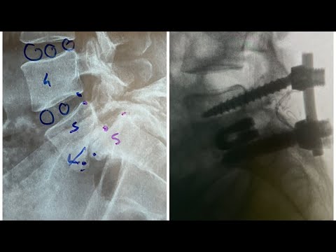 Spine related Questions and Answers : Ask Dr Ajay Kothari