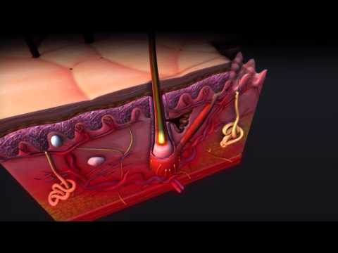 Psoriasis types in hindi