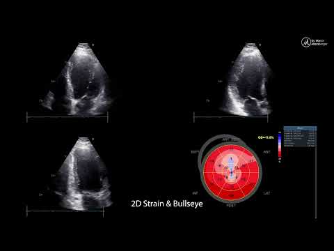 〖Echokardiografie〗 Apikale Akinesie nach STEMI im B-Bild und im Strain🫀