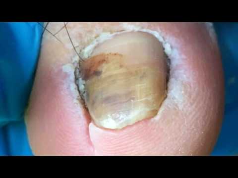 Poor Toenails Have Deteriorated, Trim The Bad Nails Carefully【Crazy pedicure room】