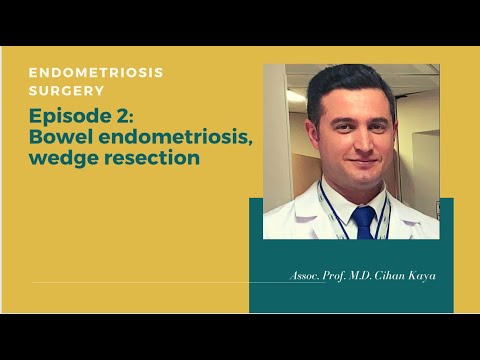 Bowel Endometriosis