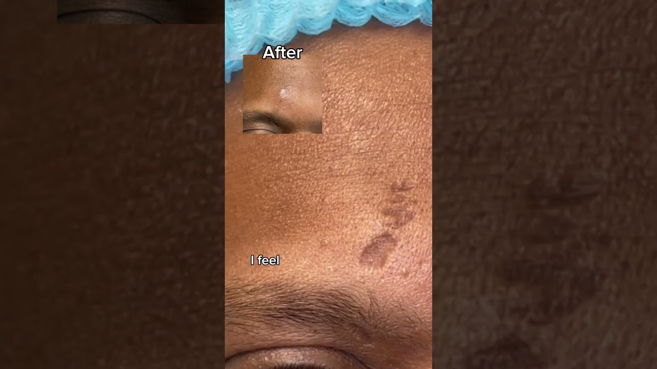 BEFORE AND AFTER OF SCAR REVISION - DR TANVEER JANJUA - NEW JERSEY