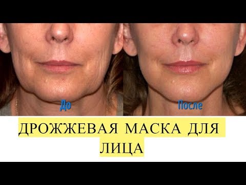 Удаление пигментных пятен на лице народными средствами. Пигментные пятна на руках после 60 лет причины