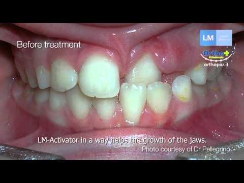 LM Activator - video [ENG]