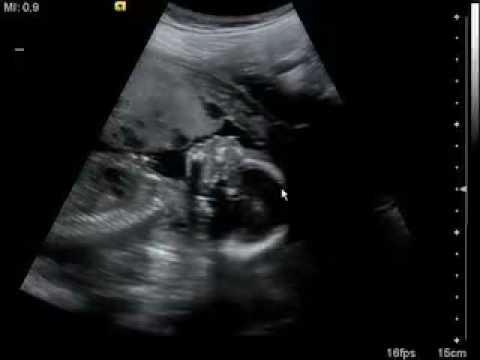 Ultraljud vecka 19+1, Ultrasound.