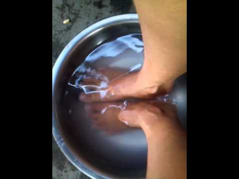 Kung paano makakuha ng isang halamang-singaw sa kanyang mga paa potasa permanganeyt Paggamot ng isang paltos sa paligid ng kuko