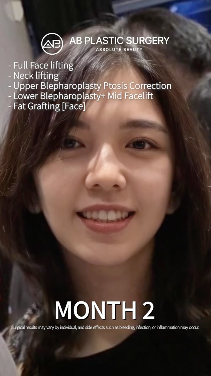 She Looks 10 Years Younger After Lower Blepharoplasty and Fat Grafting