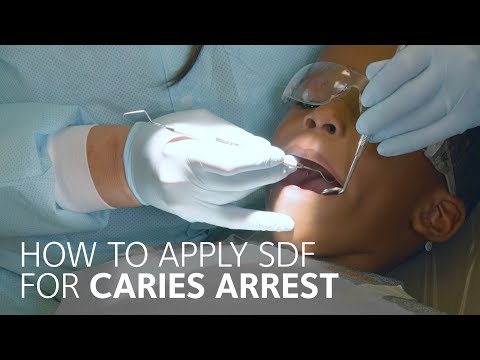 Silver Diamine Fluoride (SDF) Application: Evidence-Based Recommendations