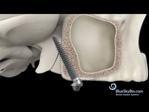 Pterygoid Implant placement