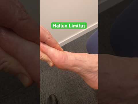 Stiff big toe? Is it Hallux Limitus ?
